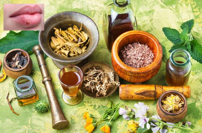 Herpes And Natural Remedies